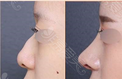 韩国VG百利酷整形外科鼻修复对比