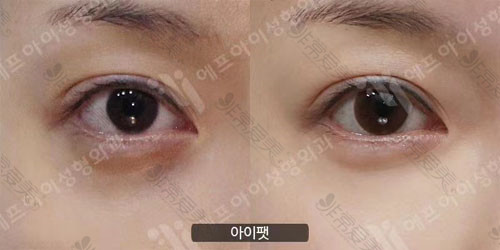 韩国富爱整形外科眼底脂肪重置对比照