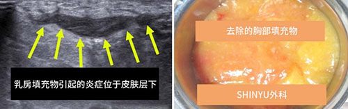韩国shinyu整形外科胸部修复案例