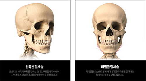 下颌角整形CT对比图