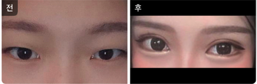 韩国Toptier整形医院眼部手术对比日记