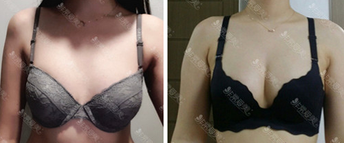 韩国Star21整形外科自体脂肪隆胸