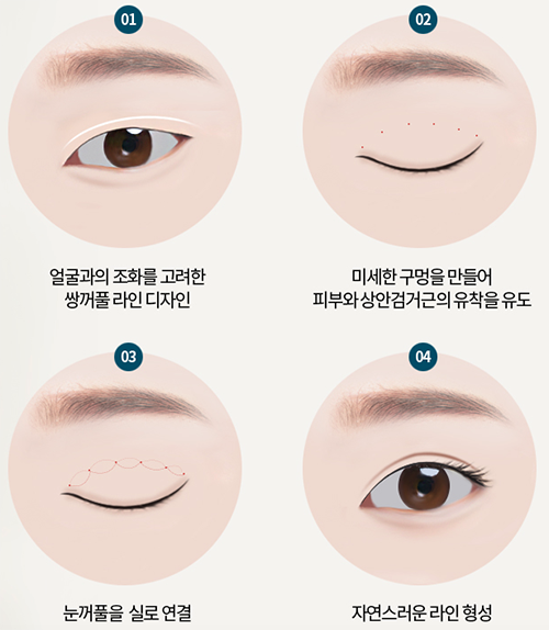 韩国toptier整形外科眼部手术过程图解