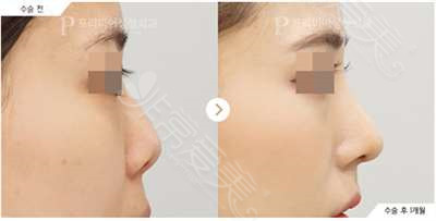 韩国普瑞美整形外科隆鼻对比