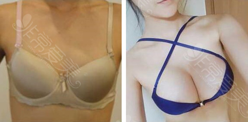 韩国k-beauty整形外科假体隆胸手术前后对比图