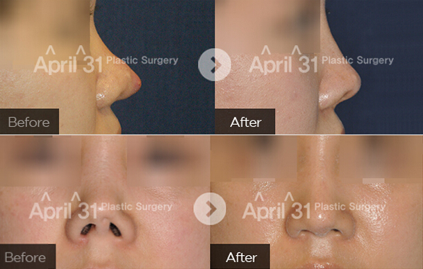 韩国4月31日整形医院鼻部修复对比图