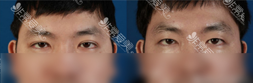 韩国BIO整形外科双眼皮松解前后对比