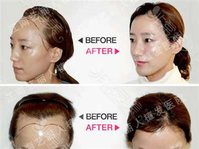 韩国艺丽人发际线种植医院毛发移植