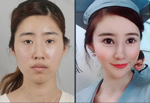 韩国ID医院双鄂手术对比图