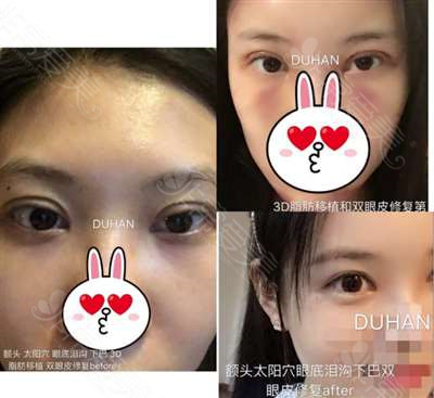 韩国DH枓翰整形外科双眼皮修复