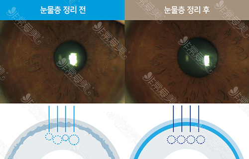 韩国光明世界眼科全飞秒与准分子激光区别图