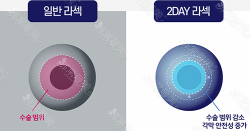 韩国光明世界眼科近视眼矫正方案对比图