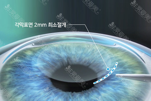 韩国光明世界眼科3Dsmile切口示意图