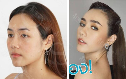 泰国Siam Laser Clinic双眼皮恢复图片对比照