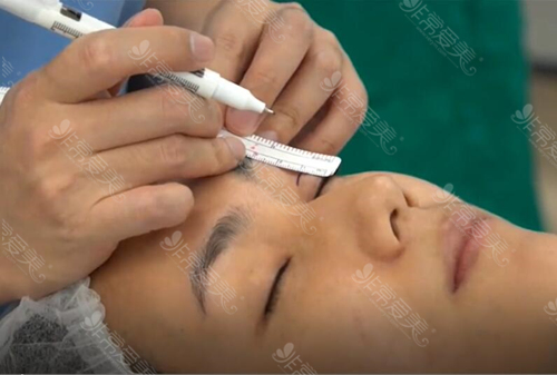 泰国SLC双眼皮整形过程图片