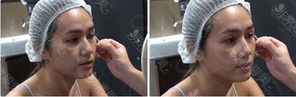 泰国slc医院双眼皮手术术前准备图