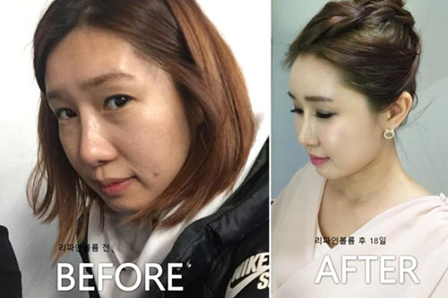 韩国piena整形外科面部脂肪移植案例