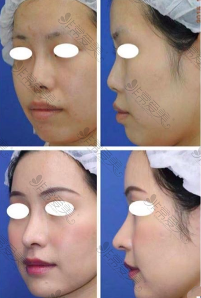 日本银座S美容形成外科鼻手术