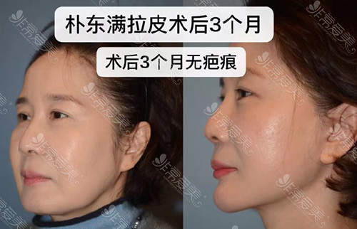 韩国BIO整形外科面部拉皮图