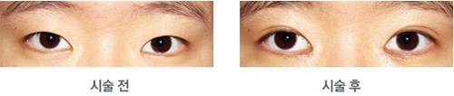 韩国medicos皮肤整形外科双眼皮手术案例