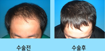 韩国medicos皮肤整形外科毛发移植对比案例
