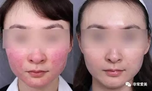 韩国皮肤科激光治疗红血丝对比