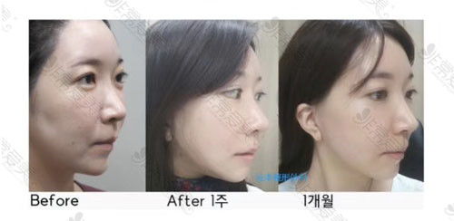韩国拉本医院拉皮手术疤痕恢复情况