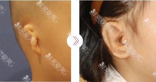 人工支架耳整形对比案例