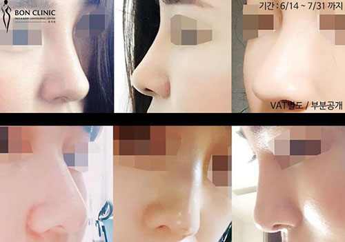 韩国Bonclinic整形外科鼻部手术日记