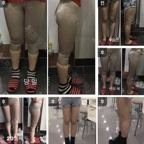 韩国Bonclinic整形外科大腿吸脂案例