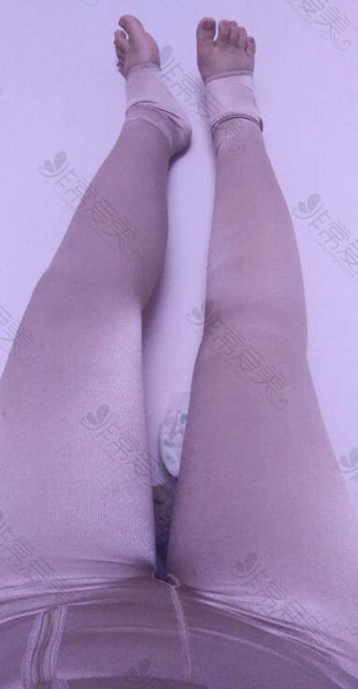 韩国Bonclinic整形外科腿部吸脂效果