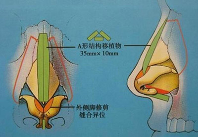 隆鼻鼻骨結(jié)構(gòu)照片