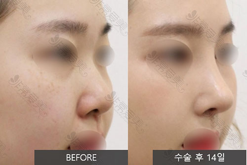 韩国louvre整形外科鼻部整形案例