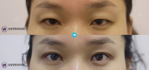 韩国UR整形外科双眼皮整形案例
