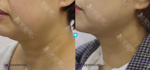 韩国UR整形外科祛颈纹效果前后对比图