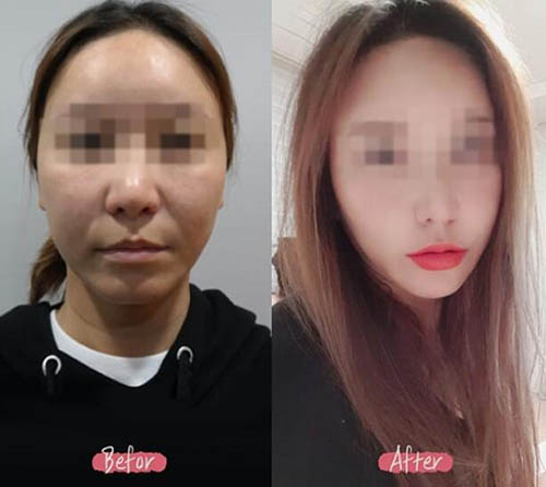 韩国Yenergy皮肤科皮肤改善案例