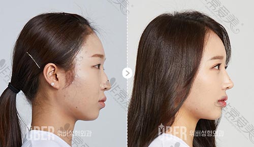 韩国玉芭整形外科隆鼻手术案例