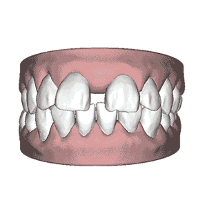 牙齿矫正前后动态图