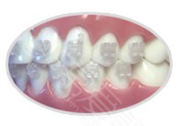 3M陶瓷托槽矫正牙齿过程图