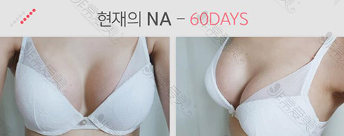 韩国娜娜整形医院胸部整形60天案例