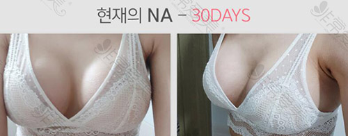 韩国隆胸30天变化效果