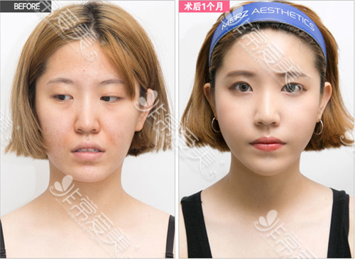韩国维摩整形外科面部填充案例