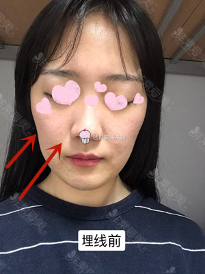韩国延世姿丽来姻皮肤科面部提升案例