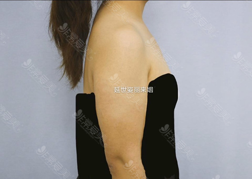 韩国延世姿丽来姻手臂环吸吸多少毫升