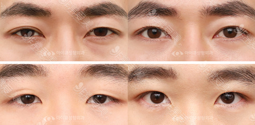 韩国IQ整形外科男生割双眼皮效果图