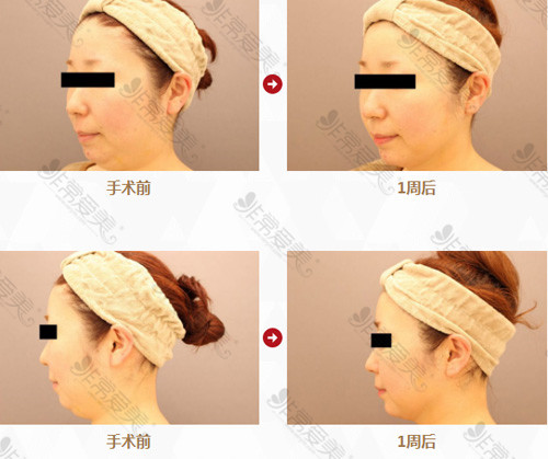 日本Mods Clinic整形外科医院面部吸脂前后对比