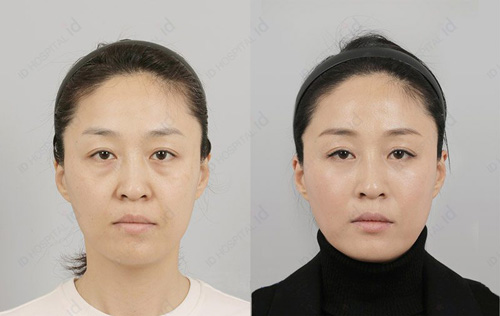 韩国id医院去眼袋手术案例