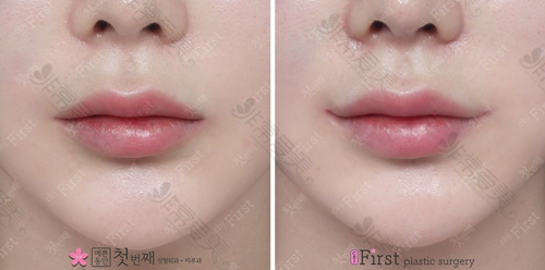 韩国初见整形外科唇部整形对比图