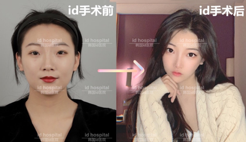 韩国ID医院面部轮廓手术对比图