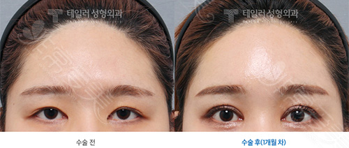 韩国卓佑炫双眼皮修复怎么样 同级别出名的修复医生还有谁?